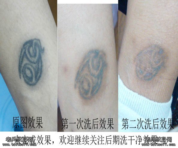 武汉专业洗纹身店,激光洗纹身不留疤痕