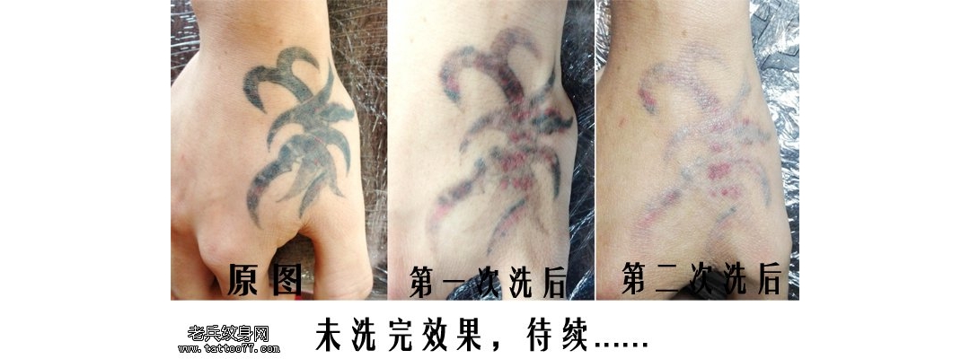 武汉专业激光洗纹身手背黑色红色皮秒洗纹身效果对比案例