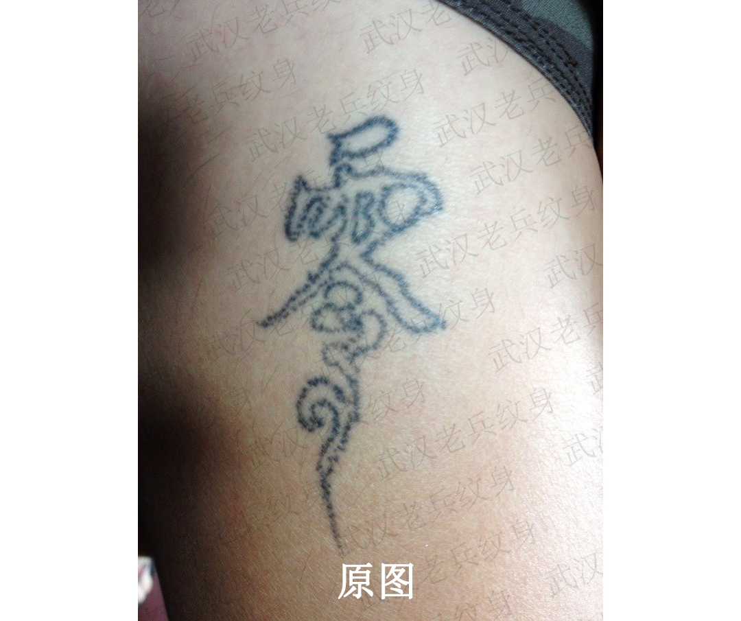 武汉专业洗纹身分享黑色文字皮秒洗纹身三次效果案例