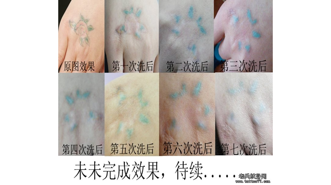 手背彩色花卉皮秒洗纹身案例由武汉专业洗纹身店提供