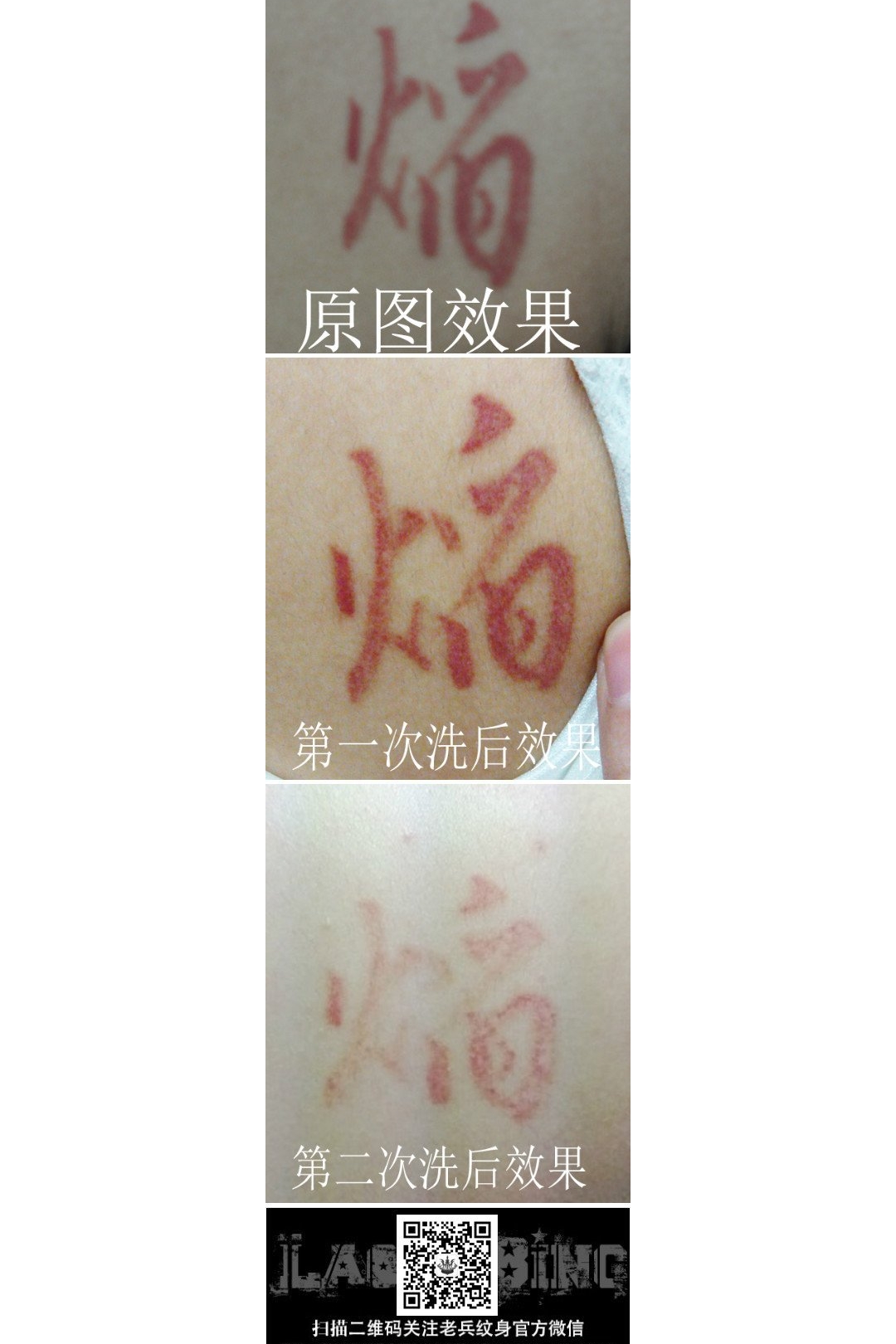 肩背红色汉字激光洗纹身案例来自武汉洗纹身最专业的店