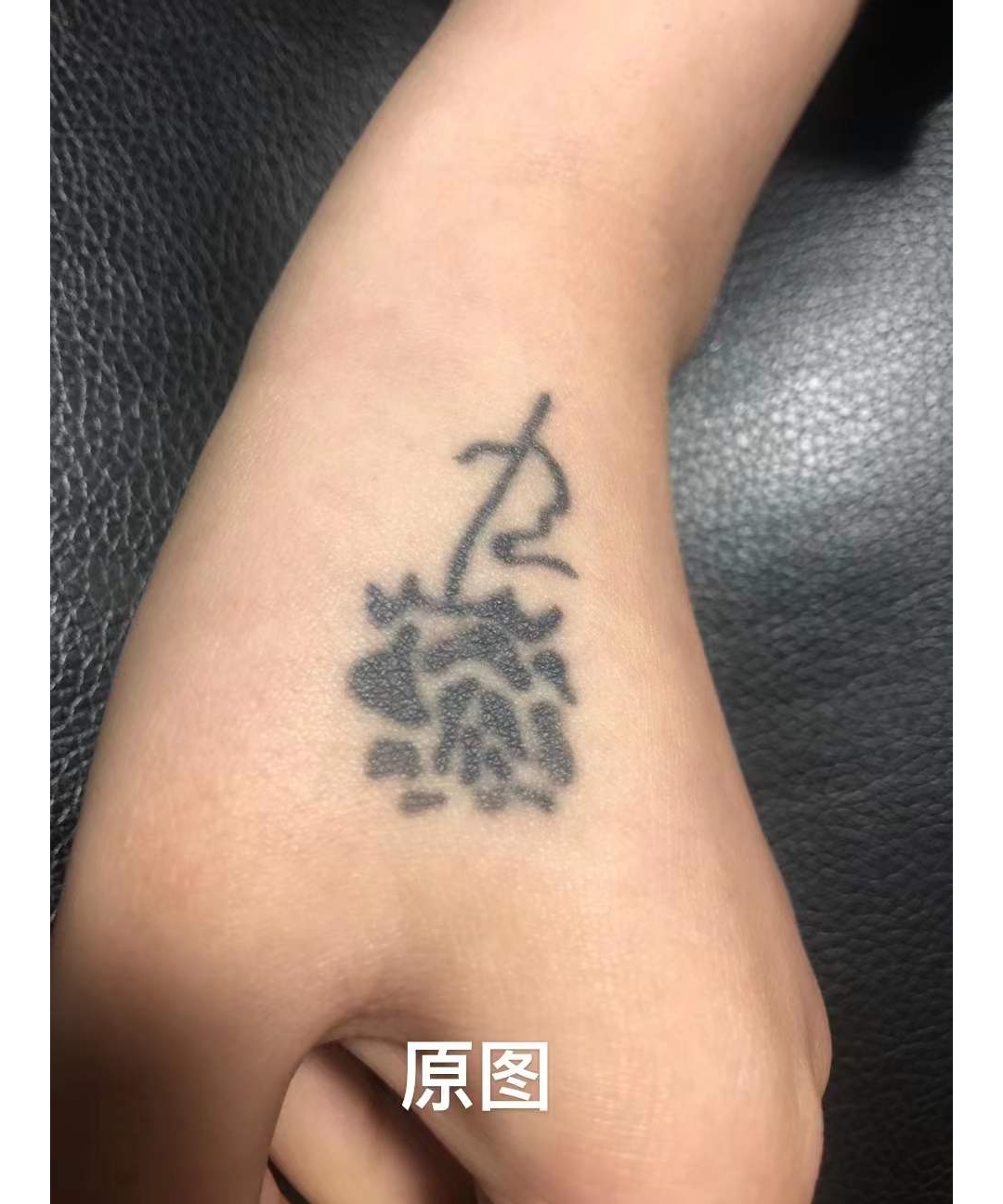 武汉皮秒洗纹身：虎口多年前纹的图腾玫瑰花纹身，两次后效果 ...